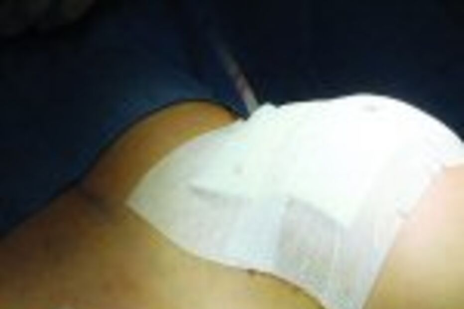 Dançarina morre no Brasil por injectar silicone industrial