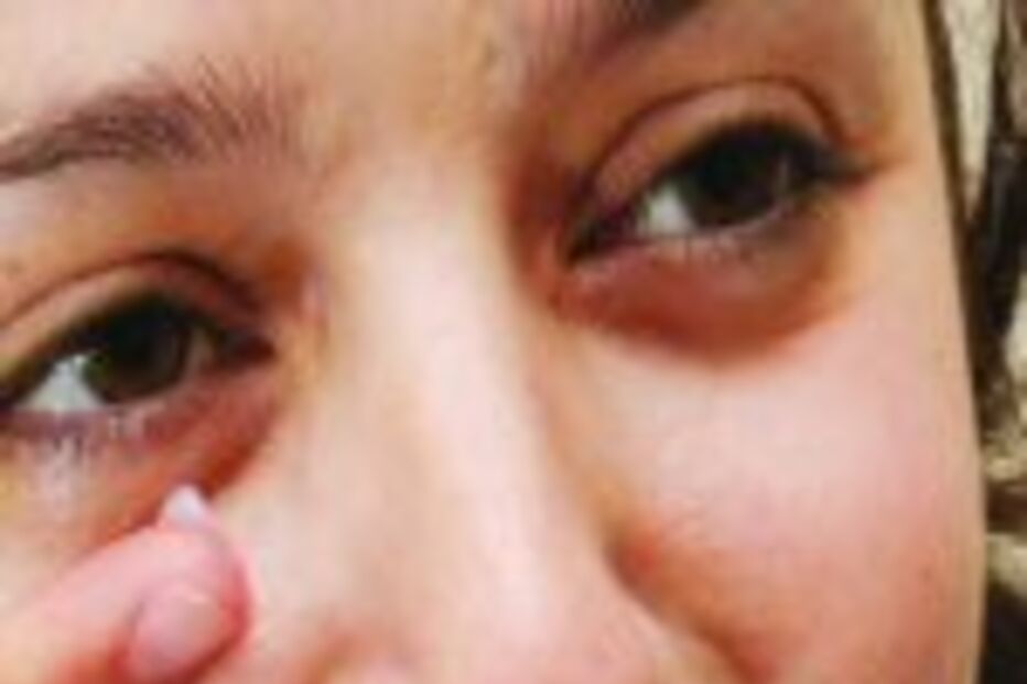 Pomada mal usada põe saúde em risco