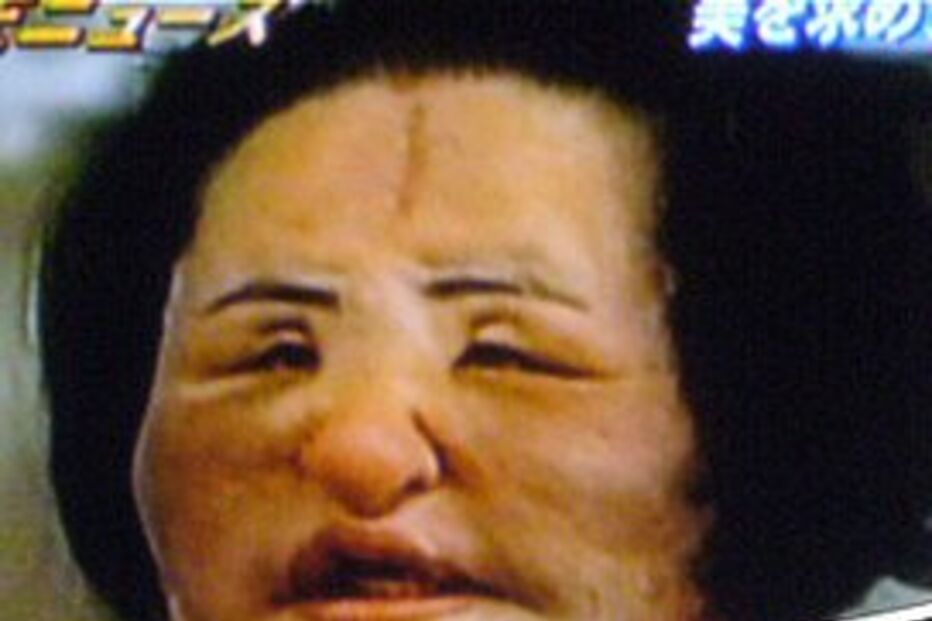 Vício da cirurgia estética acaba mal