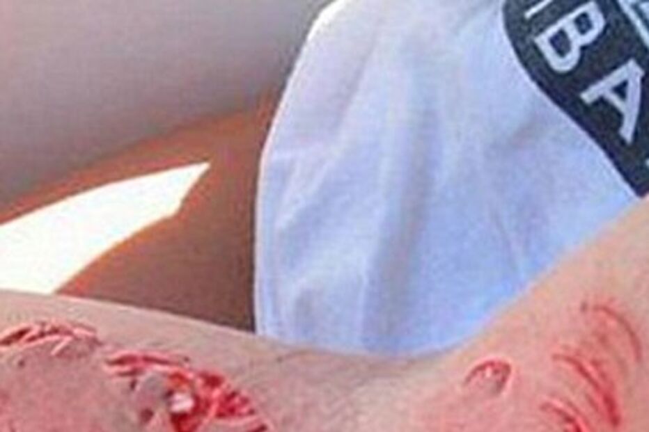 Rapariga mordida por barracuda