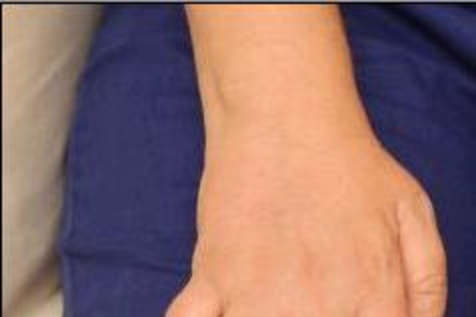 Artrite Reumatóide Saúde