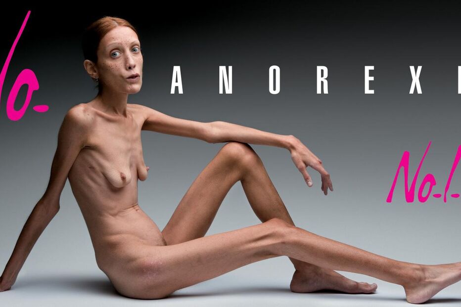 Modelo anoréctica Isabelle Caro morre aos 28 anos