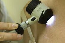 cancro da pele, francisco george, dermatologia, pele, sol, verão, doenças, cancro