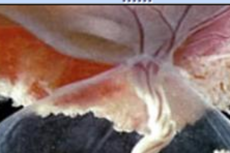 Coma, dar à luz,Inglaterra, bebé, parto, gripe suína