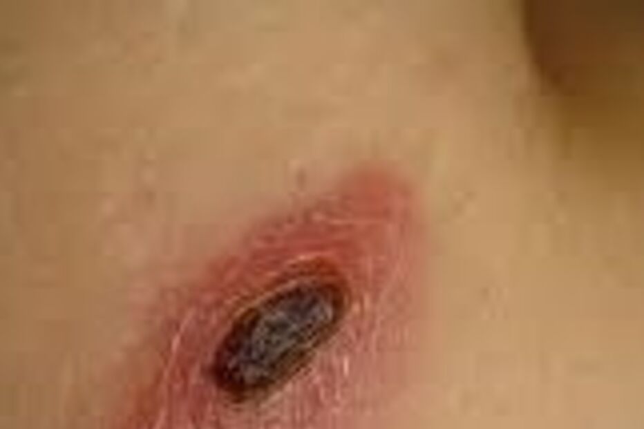 Saúde,carraça,febre,Portugal