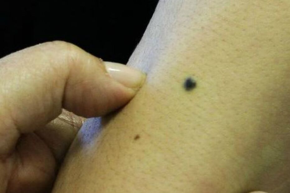 saúde, cancro, pele, ipo, rastreio, dermatologia, Euromelanoma, sinais