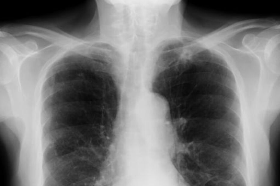 cancro, oncologia, pulmão, doença, saúde, 