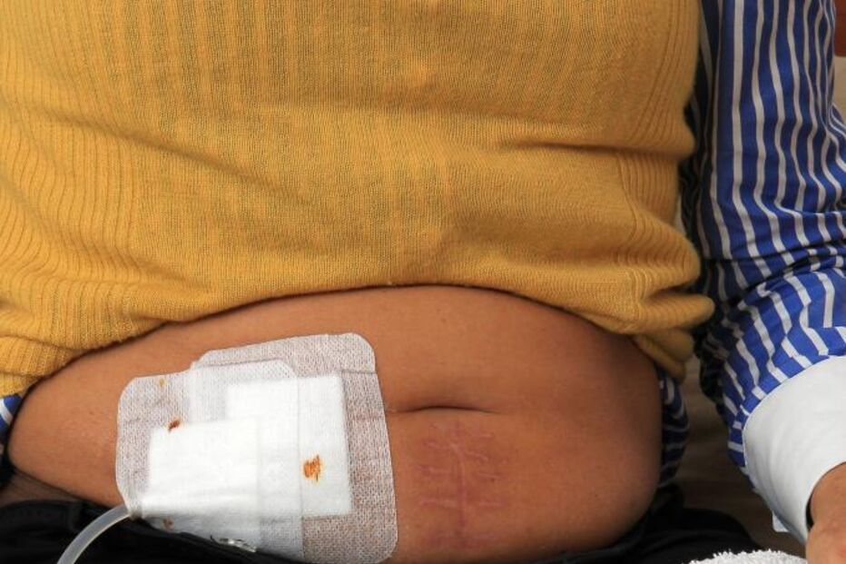 INSUFICIÊNCIA RENAL, SAÚDE, DIÁLISE