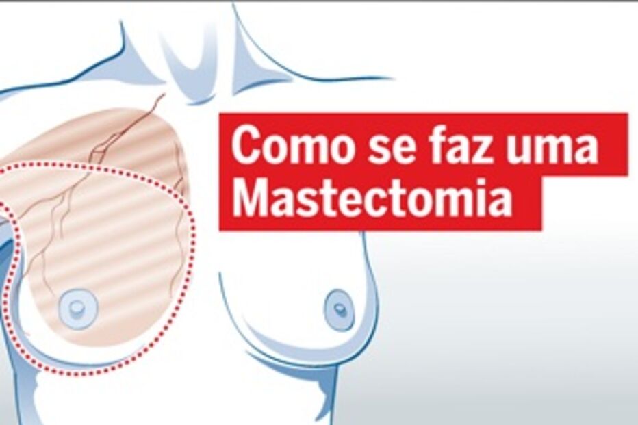 mastectomia, cancro, mama, seios, angelina jolie, doença