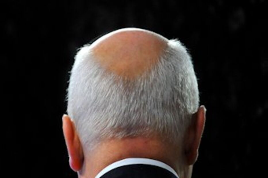 carecas, calvície, finasterida, estudo, cabelo, álcool, sexo, desejo, bebida