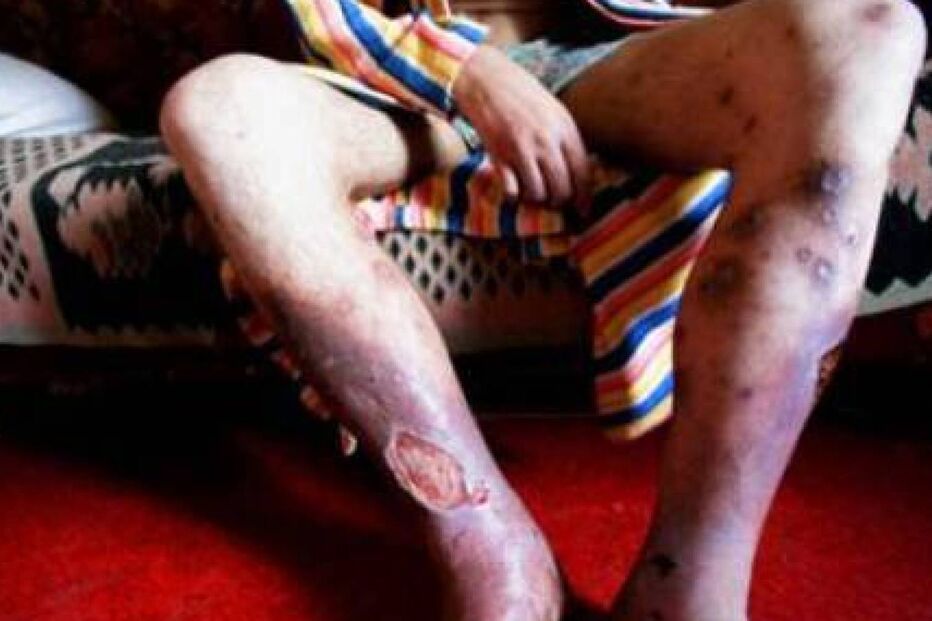 Droga, krokodil, Rússia, toxicodependência