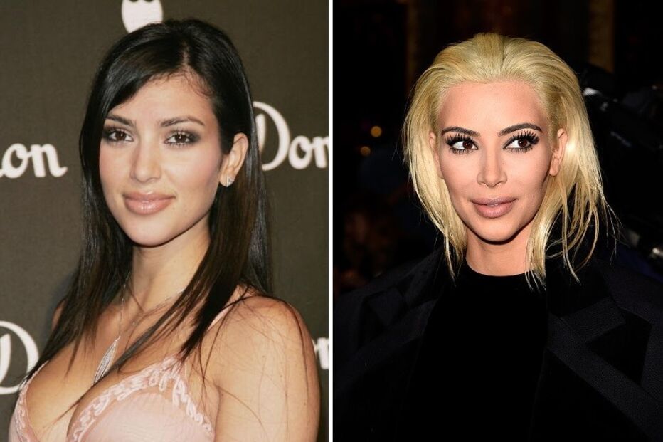 Paris Hilton, Kim Kardashian, Keeping Up With The Kardashians, saúde, cirurgia estética, enchimento, maçãs do rosto, lipoaspiração, botox