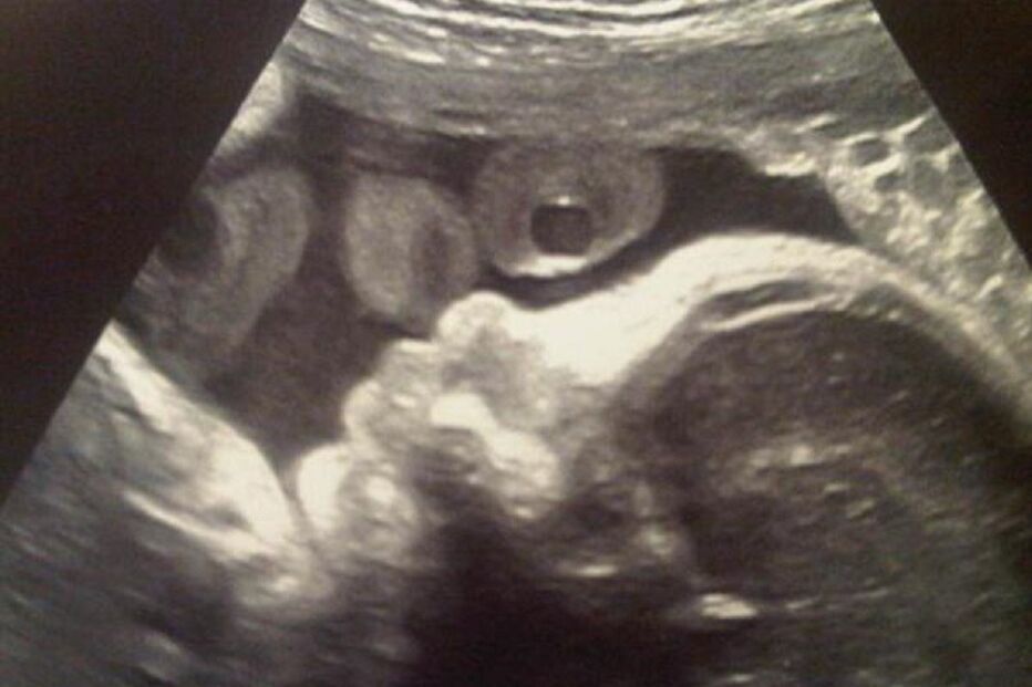 ecografia, feto, cabeça, 