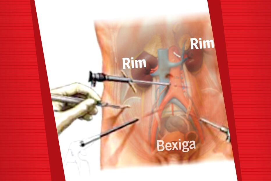 28-05-2015_01_37_19 Bolacha_Transplante_Rim.jpg
