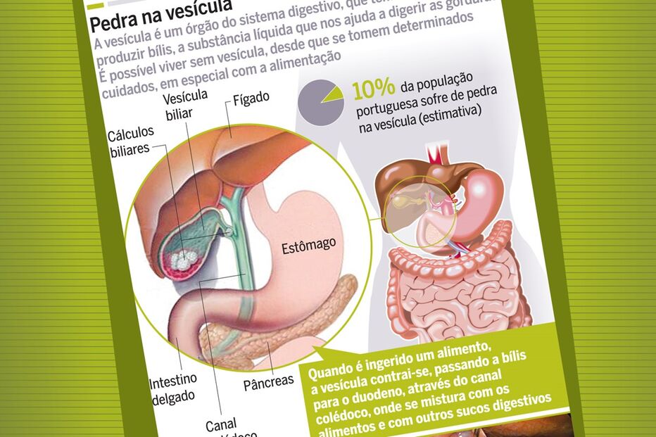 05-09-2015_01_35_31 Bolacha_PedraNaVesicula.jpg