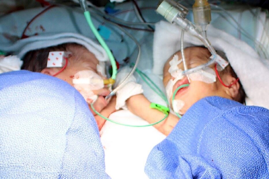 Bebés, siamesas, Suíça