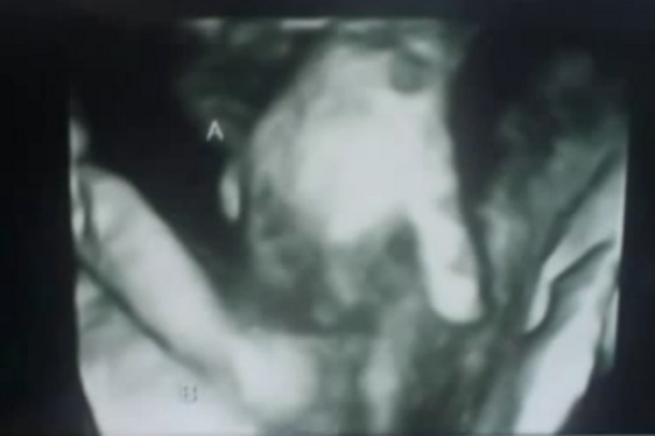 Texas, EUA, Mason, Brittany, gémeos, ecografia, mão dada