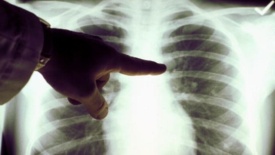 Cancro no pulmão é o mais mortífero em Portugal
