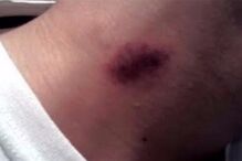 Adolescente, jovem, chupão, México, coágulo sanguíneo