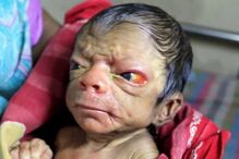 bebé, criança, Bangladesh, Benjamin Button, rugas, síndroma, Huntchinson-Gilford