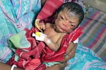 bebé, criança, Bangladesh, Benjamin Button, rugas, síndroma, Huntchinson-Gilford