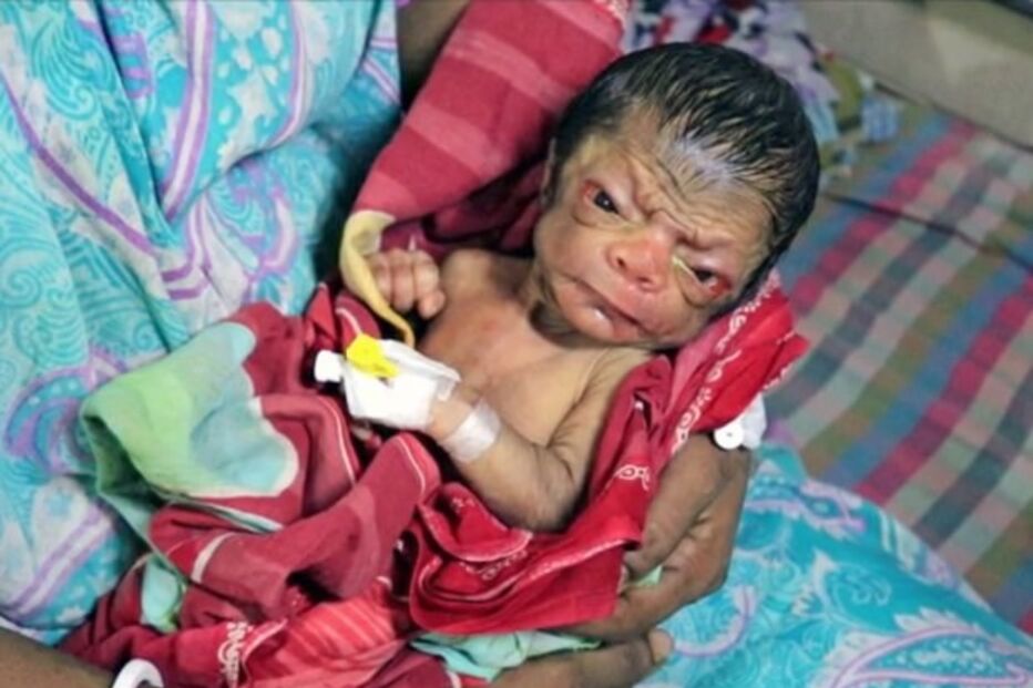 bebé, criança, Bangladesh, Benjamin Button, rugas, síndroma, Huntchinson-Gilford