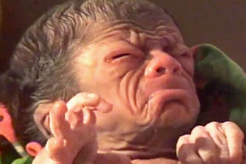 bebé, criança, Bangladesh, Benjamin Button, rugas, síndroma, Huntchinson-Gilford