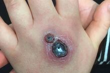 28-11-2016_17_03_44 PAY-Abbie-Kinnaird-spider-bite (2).jpg