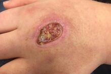 28-11-2016_17_03_46 PAY-Abbie-Kinnaird-spider-bite (1).jpg