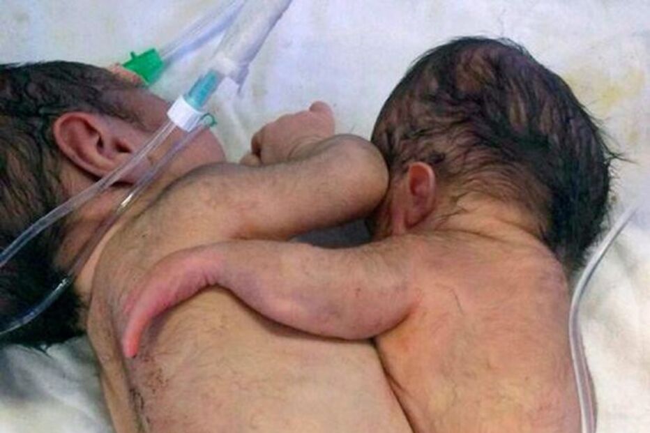 16-11-2016_16_55_47 PAY-Parasitic-twins (1).jpg