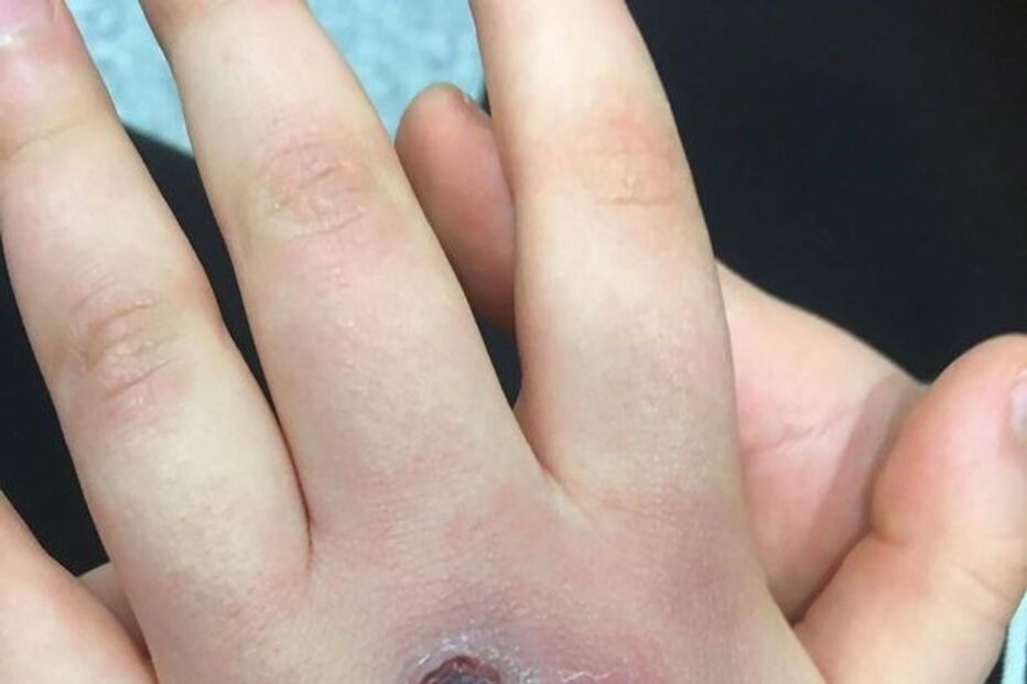 28-11-2016_17_03_44 PAY-Abbie-Kinnaird-spider-bite (2).jpg