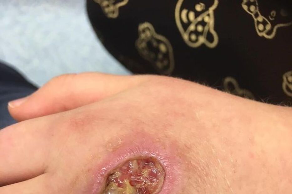 28-11-2016_17_03_46 PAY-Abbie-Kinnaird-spider-bite (1).jpg