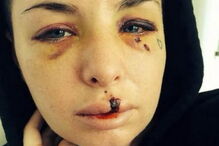 Christy Mack foi violentamente agredida pelo namorado, o lutador de MMA War Machine