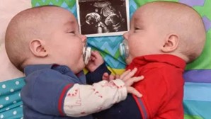 Gémeos salvam-se por estarem abraçados dentro do útero
