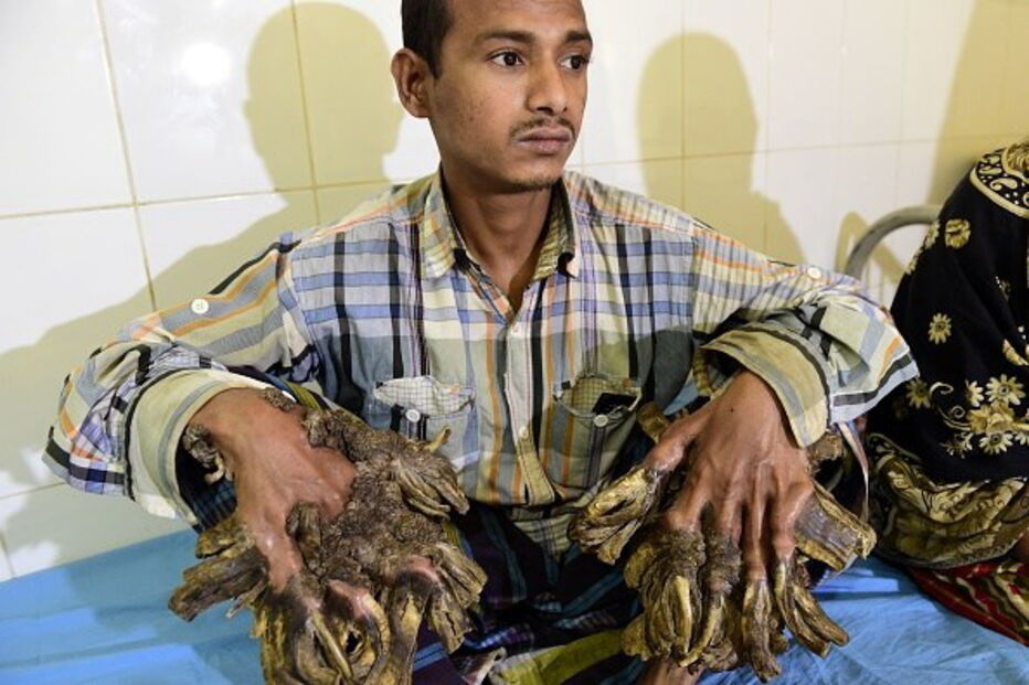 homem-árvore, Abul Bajandar, cirurgias, hospital, cura, Bangladesh, epidermodisplasia verruciforme