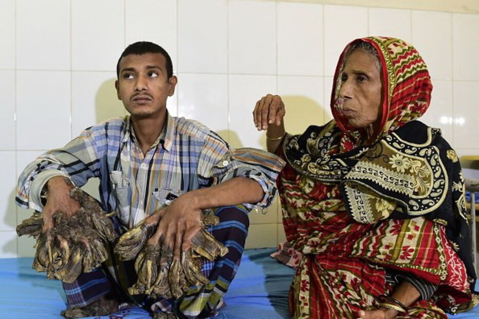 homem-árvore, Abul Bajandar, cirurgias, hospital, cura, Bangladesh, epidermodisplasia verruciforme