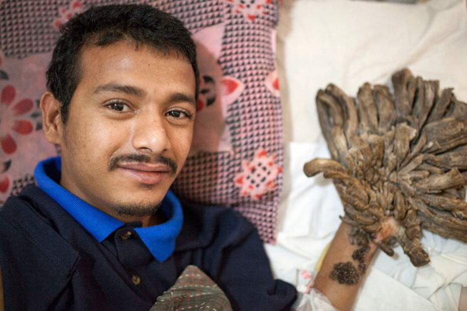 homem-árvore, Abul Bajandar, cirurgias, hospital, cura, Bangladesh, epidermodisplasia verruciforme