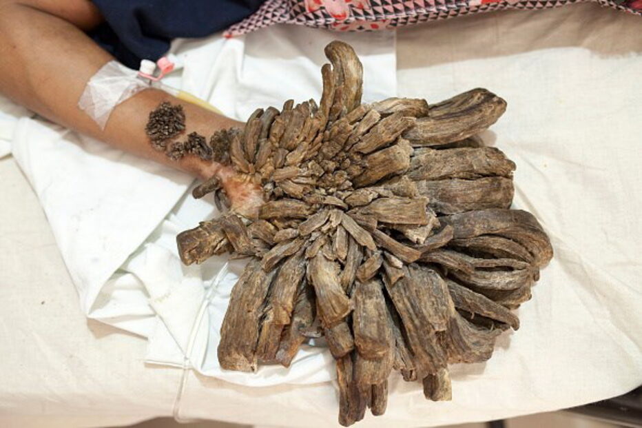 homem-árvore, Abul Bajandar, cirurgias, hospital, cura, Bangladesh, epidermodisplasia verruciforme