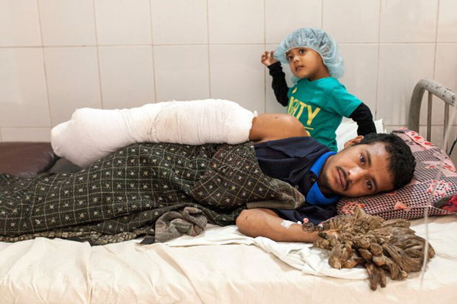 homem-árvore, Abul Bajandar, cirurgias, hospital, cura, Bangladesh, epidermodisplasia verruciforme