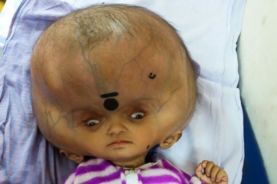 Mrityunjay Das, de sete meses, sofria de um caso extremo de hidrocefalia