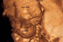 Lindsay Paradiso abortou a pequena Omara às 23 semanas, depois do tumor no pescoço da bebé triplicar de tamanho