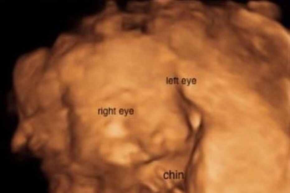 Lindsay Paradiso abortou a pequena Omara às 23 semanas, depois do tumor no pescoço da bebé triplicar de tamanho