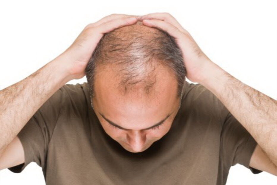 calvície, mãe, filho, perda de cabelo, genética