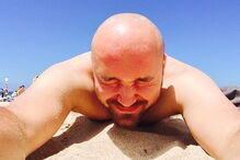 careca, queda de cabelo, calvície