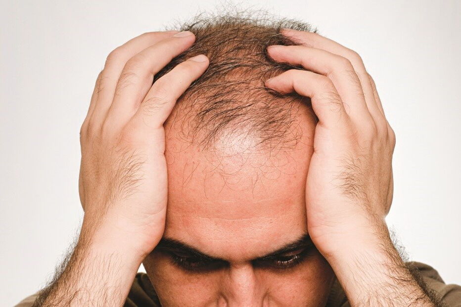 calvície, tratamentos, comprimidos, cabelo, careca