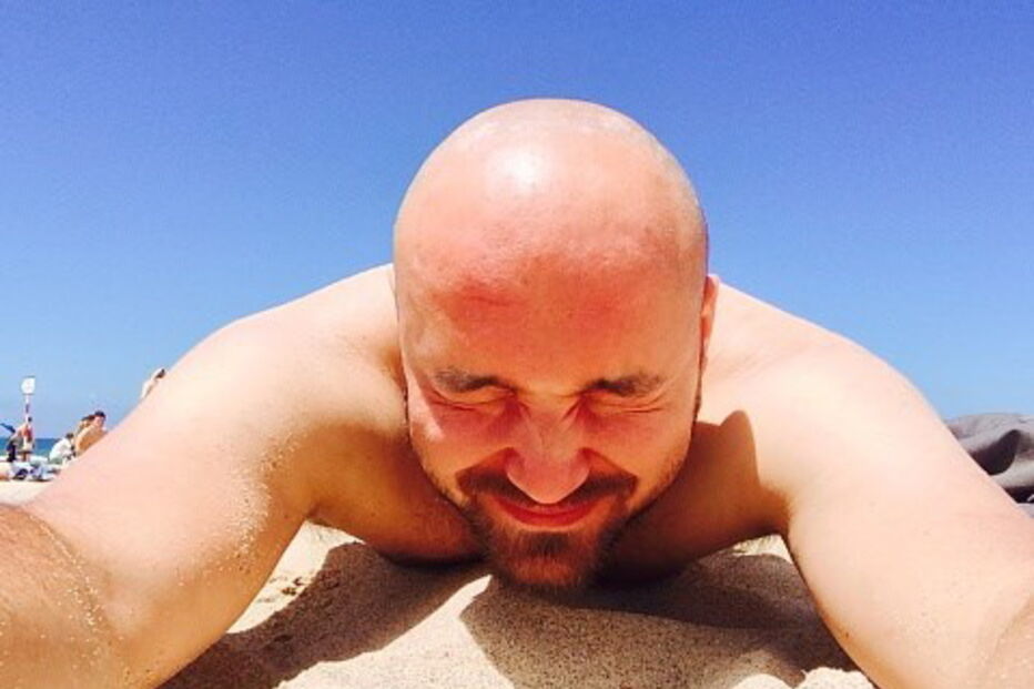 careca, queda de cabelo, calvície