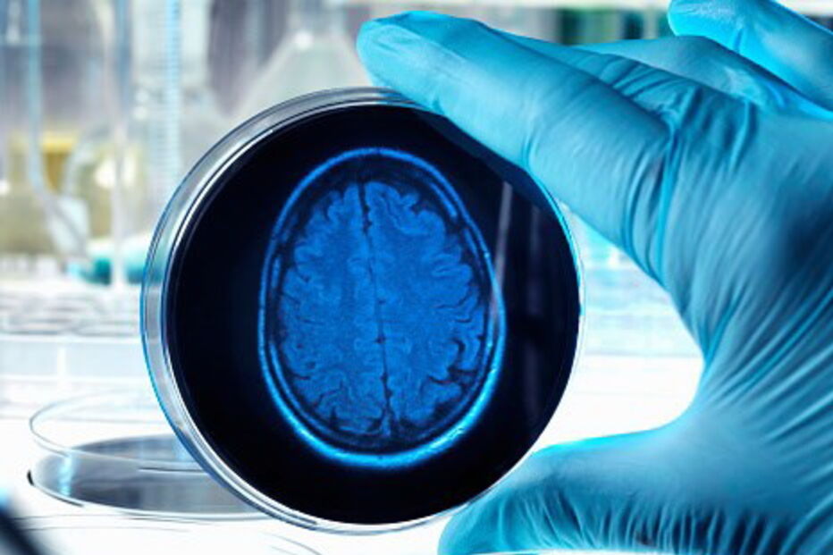 Proteína Ephexin5 parece ser elevada nas células cerebrais de doentes de Alzheimer