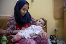 Menino iraquiano que nasceu com oito membros é operado na Índia