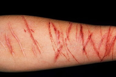 Jovens são incentivados à mutilação e ao suicídio no jogo da 'Baleia Azul'