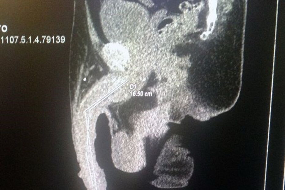 Roberto Esquivel Cabrera, de 48 anos, tem um pénis de 48 centímetros